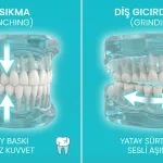 diş sıkma ve diş gıcırdatma arasındaki farklar nelerdir